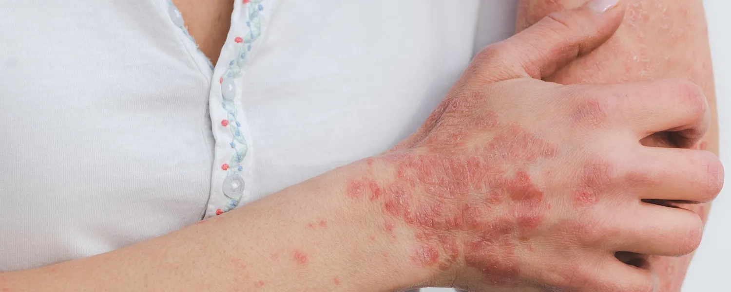 "A woman's arm showing red, scaly psoriasis plaques on the skin, highlighting symptoms of chronic inflammation.