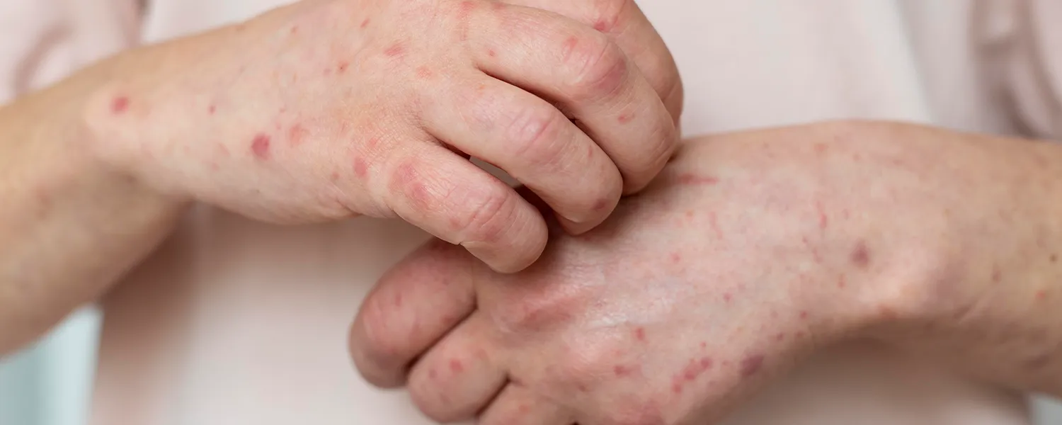 Measles, including its history, transmission, symptoms, complications, prevention through vaccination